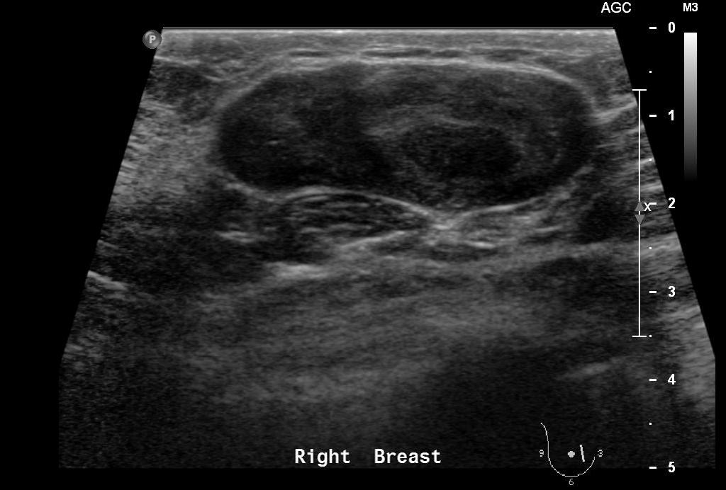 File:Ultrasound fibro 1.jpg