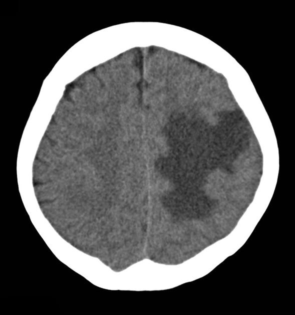 Noncontrast CT scan of a 70 year old female with a known history of metastatic colorectal cancer, presenting with right sided hemiparesis, demonstrates a 2cm rounded mass is present in the post-central gyrus, which is iso-dense to cortex pre-contrast and demonstrates homogeneous contrast enhancement. It is located at the grey-white matter interface and is surrounded by extensive vasogenic edema, which exerts significant mass effect.[8]