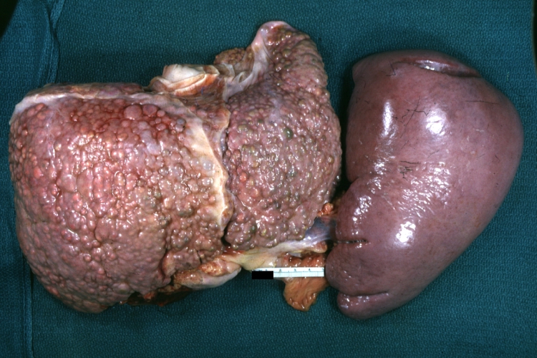 Macronodular cirrhosis: Gross, natural color, external view of liver and very enlarged spleen (liver has variable size nodules up to about 2 cm)