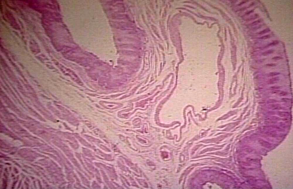 Histological findings in esophageal varices, source:Pathguy.com