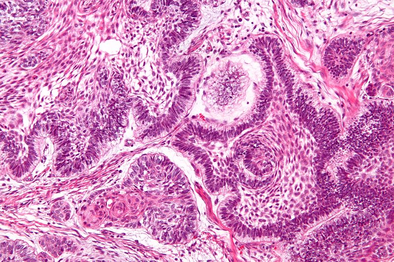 File:800px-Ameloblastoma - high mag.jpg