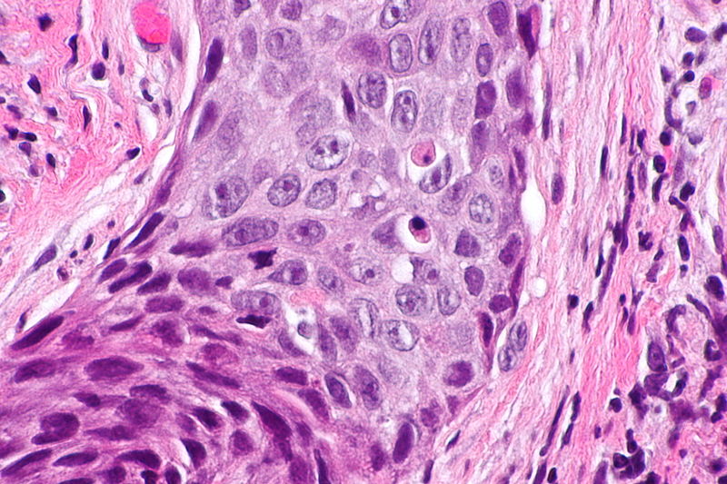 File:800px-Laryngeal squamous carcinoma -- very high mag.jpg
