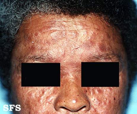 File:Lepromatous leprosy02.jpg