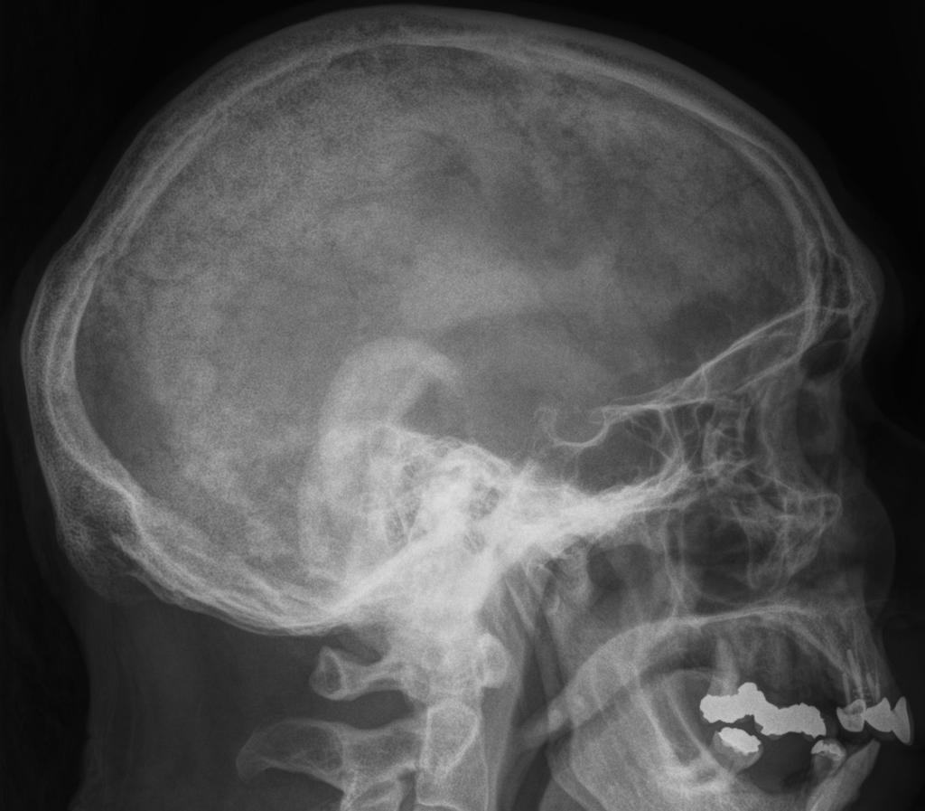 File:Paget-disease-skull-1.jpg