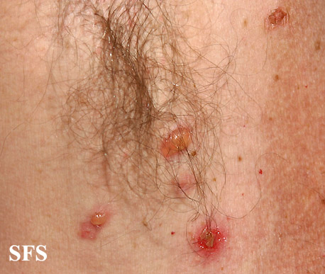 Pemphigus vulgaris. With permission from Dermatology Atlas.[3]