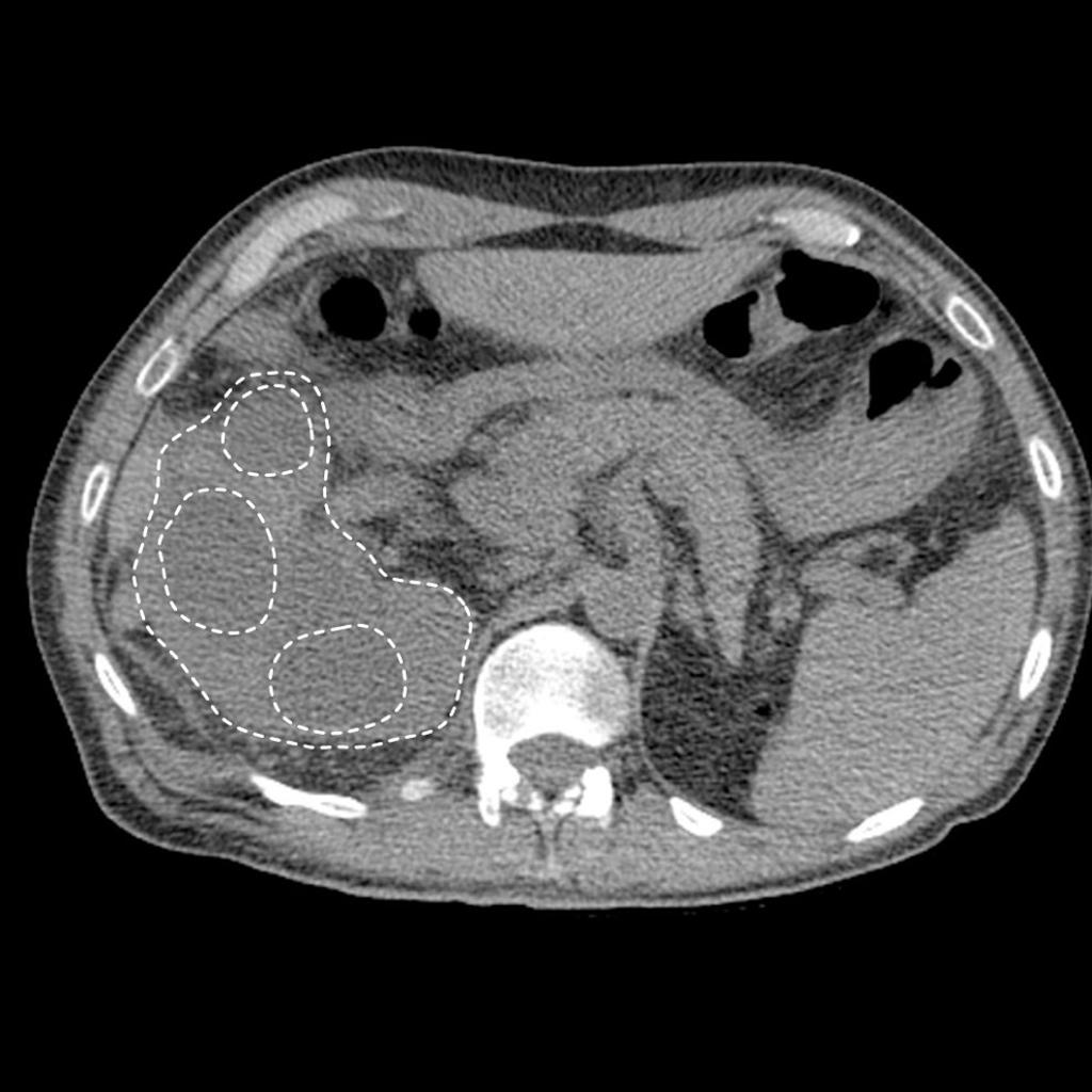 CT image demonstrates right xanthogranuomatous pyelonephritis with dilated calyces