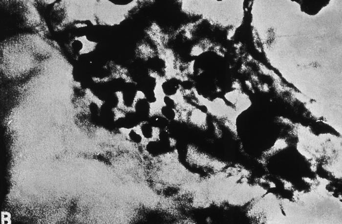 Dieterle’s silver stain under photomicrographic examination, image reveals presence of numerous Donovan bodies. From Public Health Image Library (PHIL). [5]