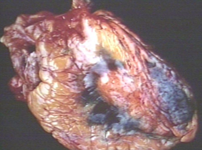 Disseminated intravascular coagulation; External surface of the heart showing epicardial petechiae