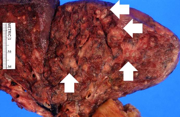 This is a closer view of the lung from this case. In this section of upper lobe there are multiple areas of early abscess formation (arrows). Note the circumscribed whitish-tan lesions. These lesions are filled with white blood cells.