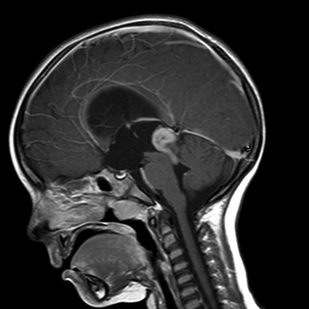 Sagittal T1 with contrast CT image of pineoblastoma demonstrating an enhancing mass in the region of the pineal gland is present. A tongue of tissue is observed extending inferiorly through the aqueduct, obstructing it, and resulting in hydrocephalus with transependymal edema.[25]