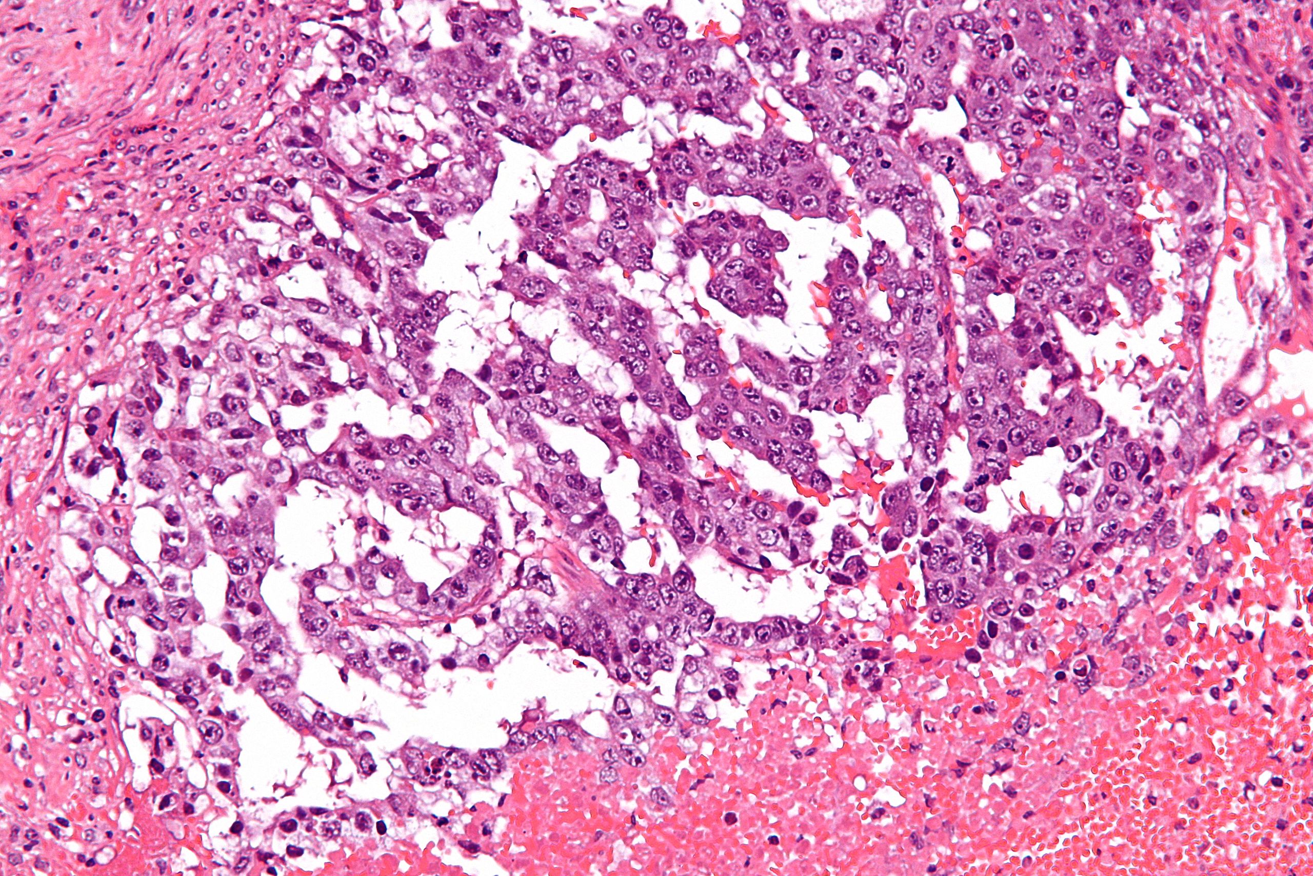 File:Mixed germ cell tumour - high mag.jpg
