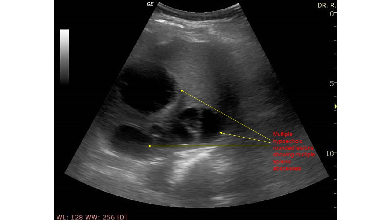 File:Multiple splenic abscesses ultrasound.jpg