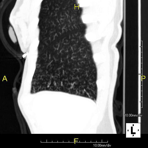 Sagittal CT image showing "tree in bud" appearance of mucous impaction in distal small airways related to primary ciliary dyskinesia