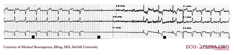 File:Pacemaker implant EKG.jpg
