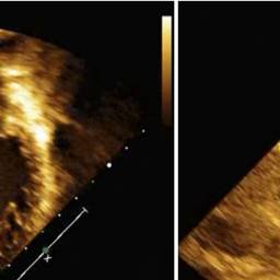 Transthoracic echocardiogram showing severe dilation and systolic dysfunction of the left ventricle