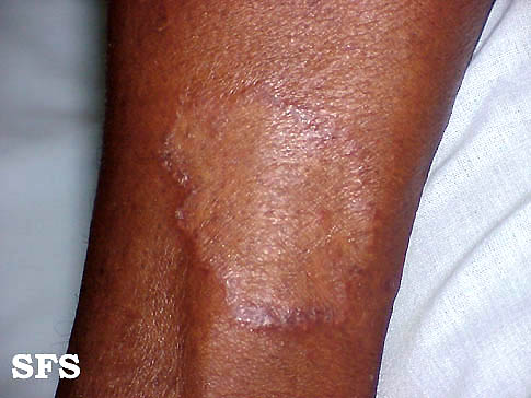 File:Tuberculoid leprosy02.jpg