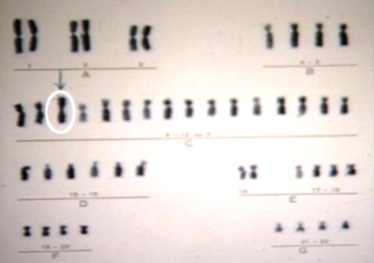Turner's karyotype 46x 150x.