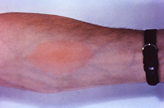 Large red spot formed at volar surface of patient's left arm, indicating a positive result to a skin test to determine whether patient was exposed to the Coccidioides spp. fungal organism. From Public Health Image Library (PHIL). [6]