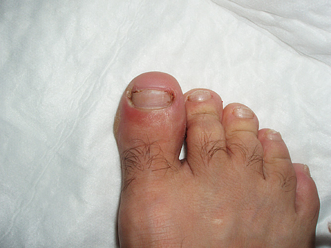Paronychia: Infection of the skin medial and inferior to nail of great toe. (Courtesy of Charlie Goldberg, M.D.)