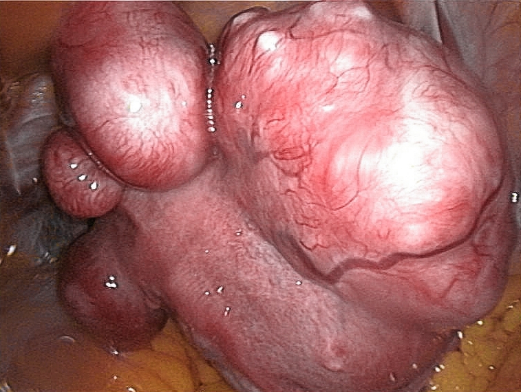 File:Uterine fibroids.jpg