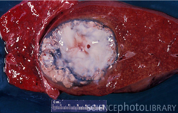 Amoebic liver abscess[14]