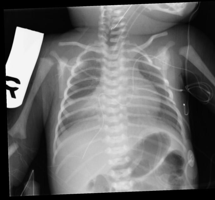 Chest x-ray of a patient with persistent SVC (Courtesy of RadsWiki and copylefted)