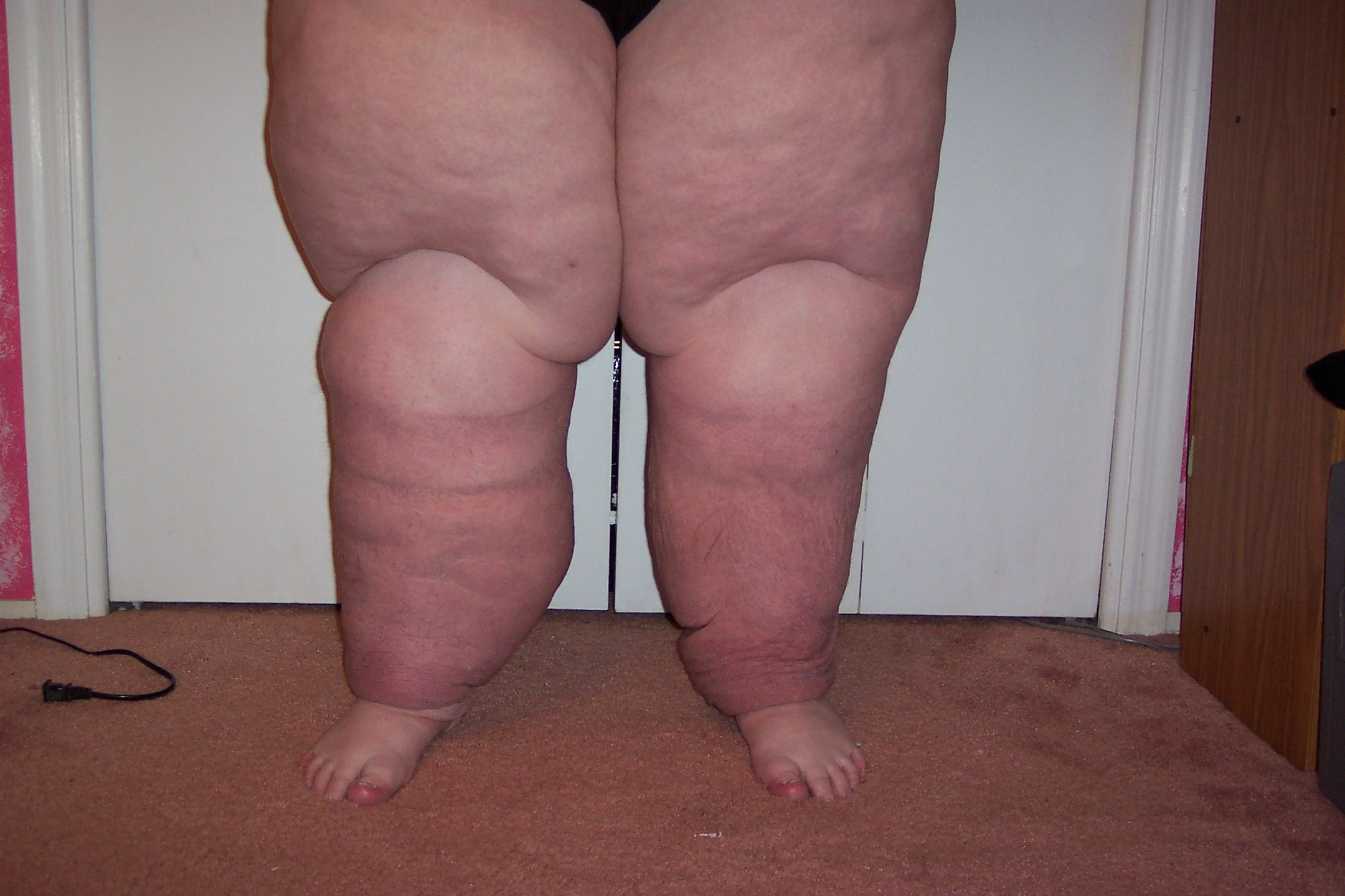 Stage 3 lymphedema front view after treatments, 65 pounds lost in 14 days