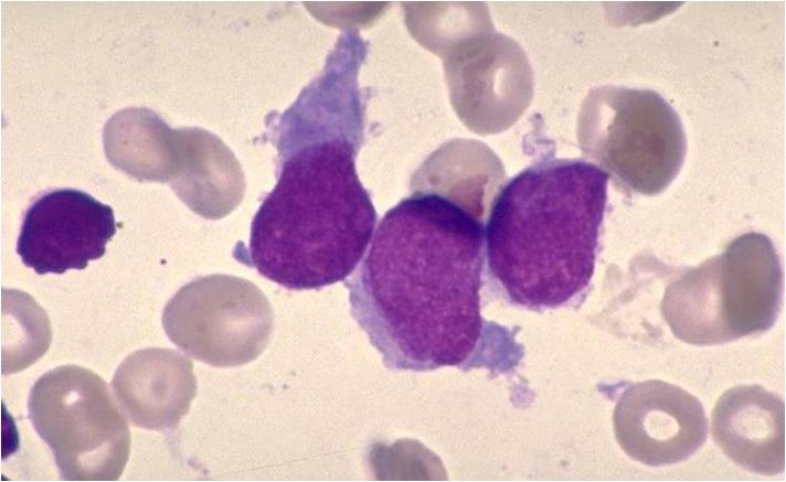 AML-M7 - irregular cytoplasmic border is often noted in some of the megakaryoblasts and occasionally projections resembling budding atypical platelets are present.