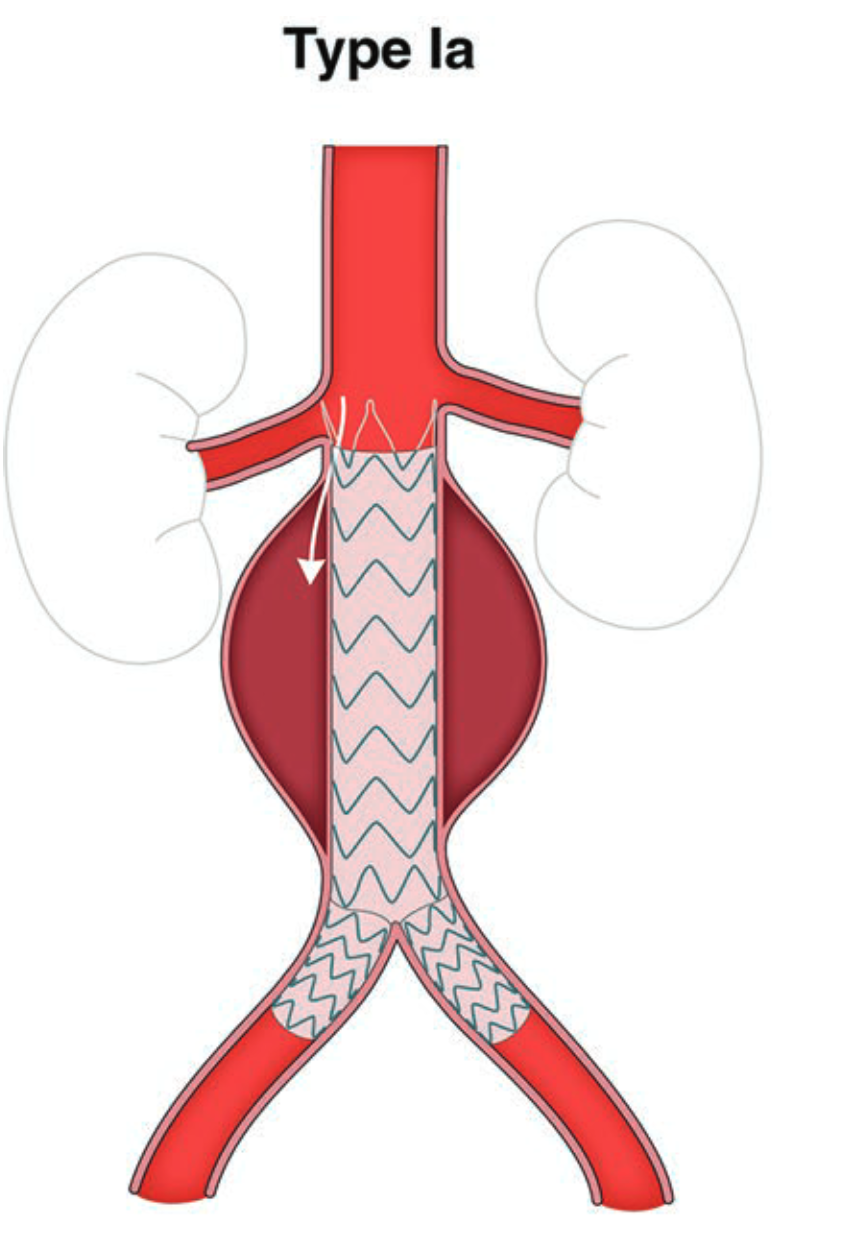 File:AorticAneurysmType1a.png