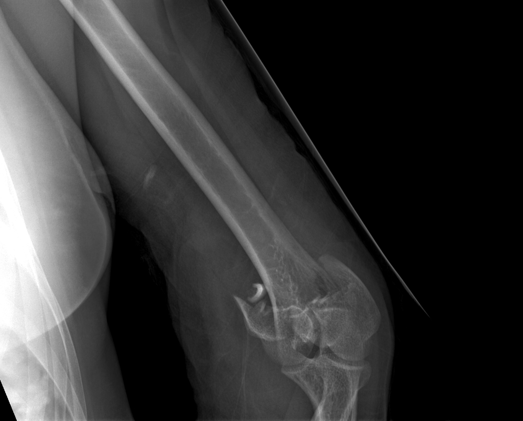 File:Displaced-t-condylar-and-supracondylar-fracture-of-the-distal-humerus (1).jpg