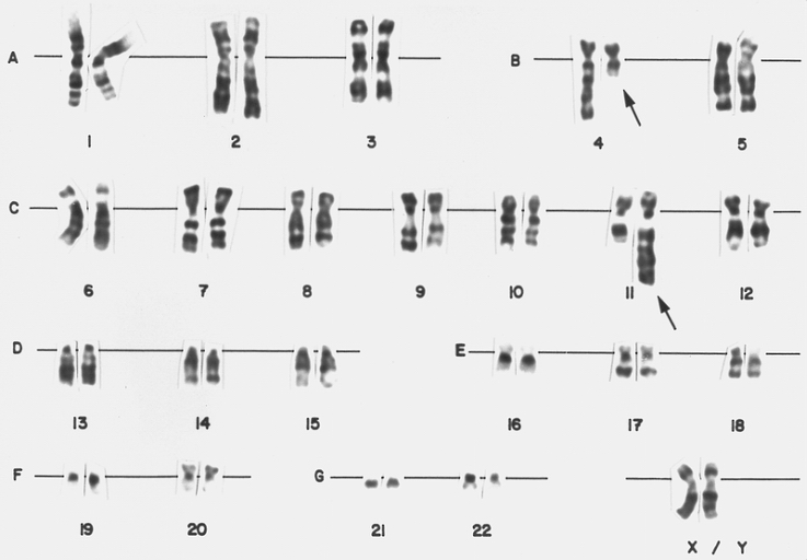 Lymphoblast karyotype from a patient with mixed phenotype acute leukemia (Bilineal). A karyotype from bone marrow cells of the patient whose blood smear is depicted in figure 146. There is a translocation of material from the long arm of chromosome 4 to the long arm of chromosome 11, t(4;11) (q21;q23). This translocation is found in less than 5 percent of cases of childhood ALL. It is associated with markedly elevated leukocyte counts and poor prognosis. Approximately 20 percent of patients are less than 1 month of age at diagnosis (congenital leukemia).