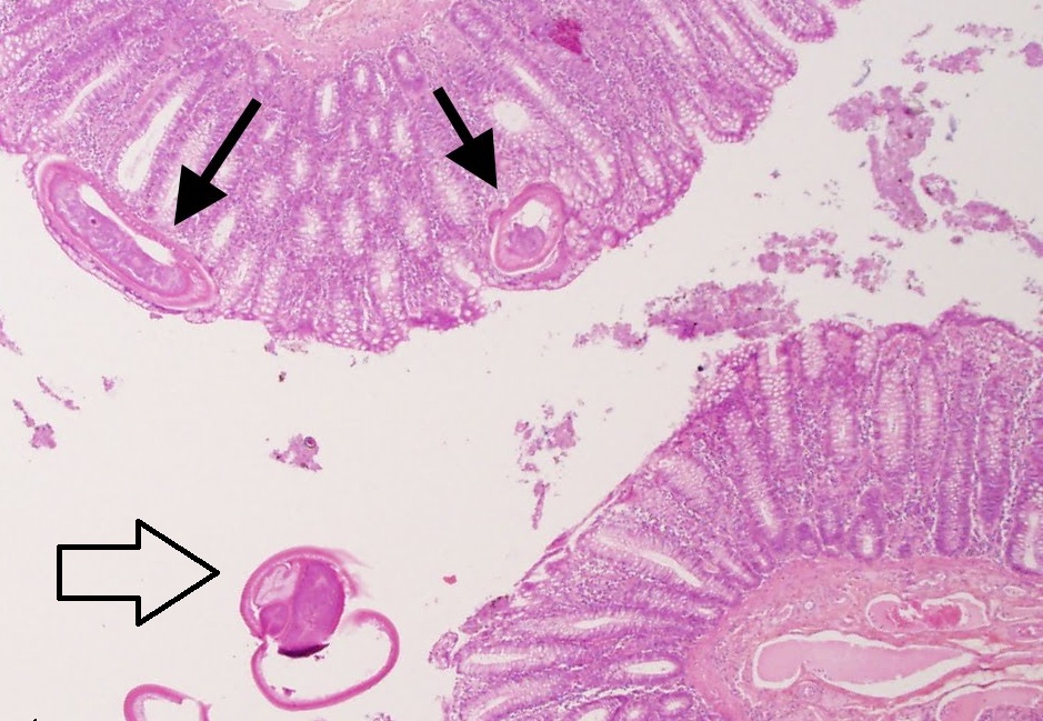 Black arrows showing worm embeded in mucosa of colon and white arrow showing one end of worm in lumen