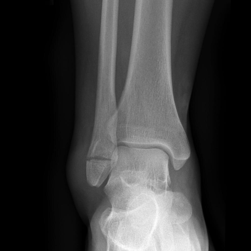 Frontal Three views of the ankle demonstrate a horizontal fracture through the lateral malleolus, below the level of the ankle joint, consistent with a Weber A fracture.