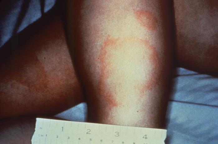 Medial aspect of the right calf of a patient who’d presented with what was diagnosed as Lyme disease. From Public Health Image Library (PHIL). [3]