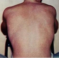 The above picture is a rash typically associated with Dengue fever. Source: CDC