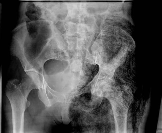 X ray of hip showing subcutaneous gas - Case courtesy of Dr Wael Nemattalla, Radiopaedia.org, rID: 8674