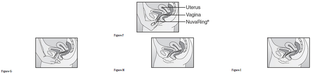 Etonogestrel and Ethinyl Estradiol Vaginal Ring - wikidoc