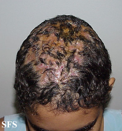 .kerion celsi Adapted from Dermatology Atlas.[1]