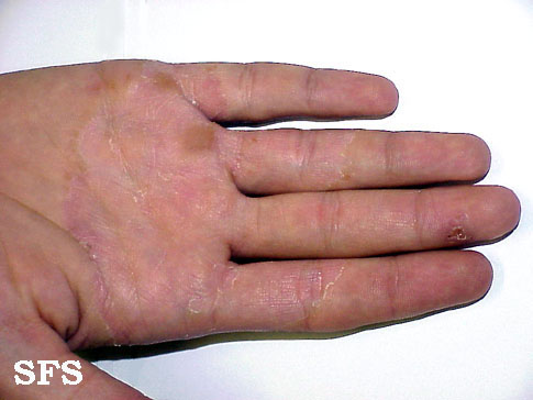 Tinea manuum. Adapted from Dermatology Atlas.[1]