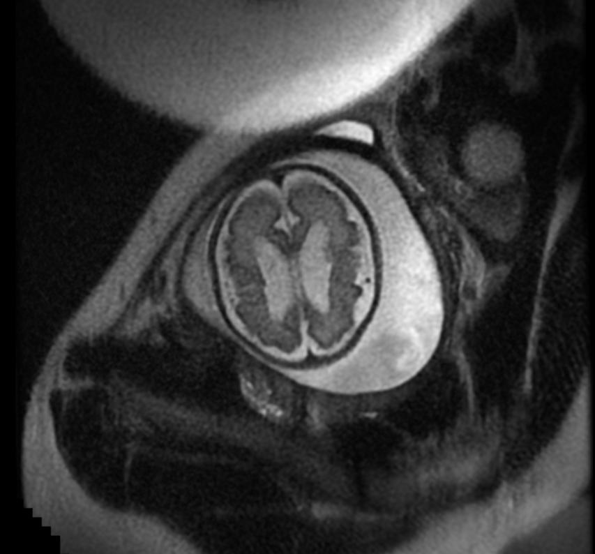 File:Aqueductal stenosis fetal MRI 004.jpg