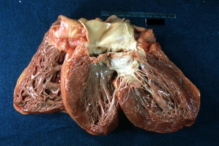 Aortic Stenosis Bicuspid: Gross; natural color opened left ventricular outflow tract with calcific masses on valve as well as anterior leaflet mitral valve probably did not cause significant stenosis