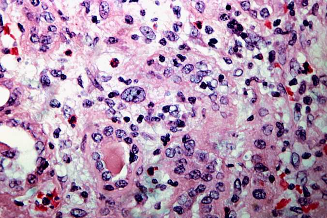 This is a high-power photomicrograph of renal cortex with cellular infiltrate and few remaining renal tubules. The cellular infiltrate comprises macrophages, activated (large) lymphocytes and a few neutrophils and plasma cells.