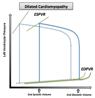The pressure volume loop in dilated cardiomyopathy. Note that the normal pressure volume diagram is in dotted line
