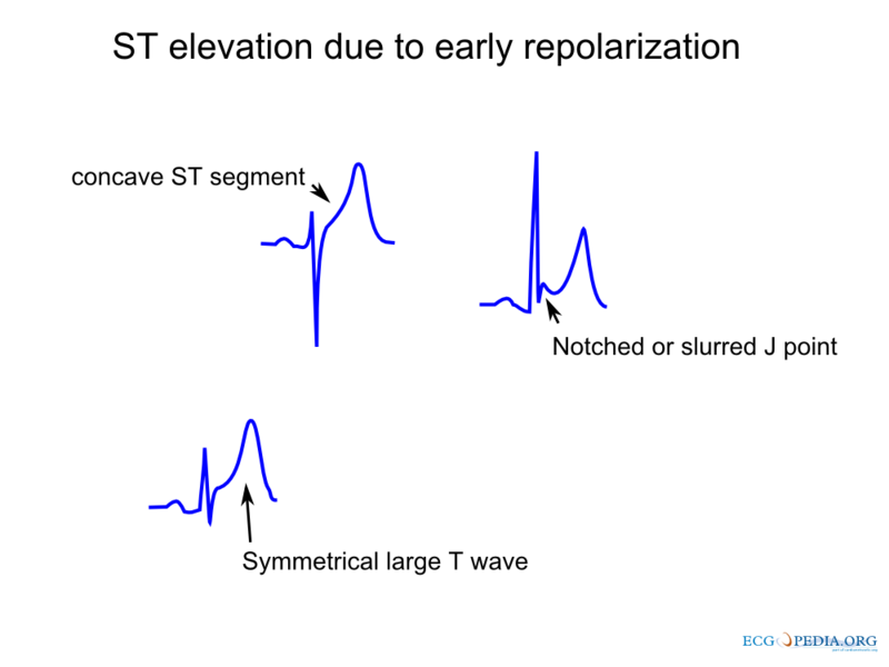 ST elevation due to repolarization.