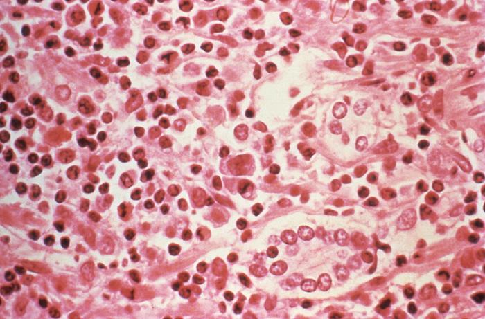 This is a micrographic study of liver tissue from a Hantavirus pulmonary syndrome (HPS) patient. From Public Health Image Library (PHIL). [1]