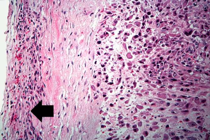 This is a high-power photomicrograph of the tumor cell morphology and the periosteum (arrow).