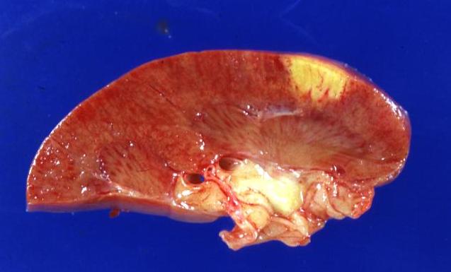 Kidney infarct: (Gross) A natural color close-up and excellent image of yellow infarct marantic endocarditis on aortic and mitral valves