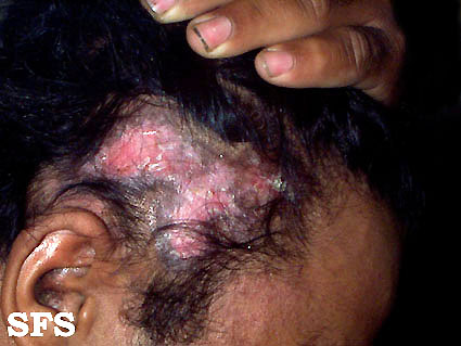 Discoid lupus erythematosus. Adapted from Dermatology Atlas.[1]