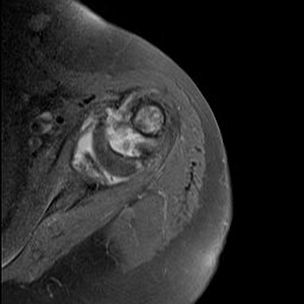 Axial STIR-Complete fracture of the anatomical neck of the humeral head with displaced bone fragments, and rotation and bone resorption. Presence of fluid between the bone fragments, with joint effusion and significant synovial thickening (synovitis).