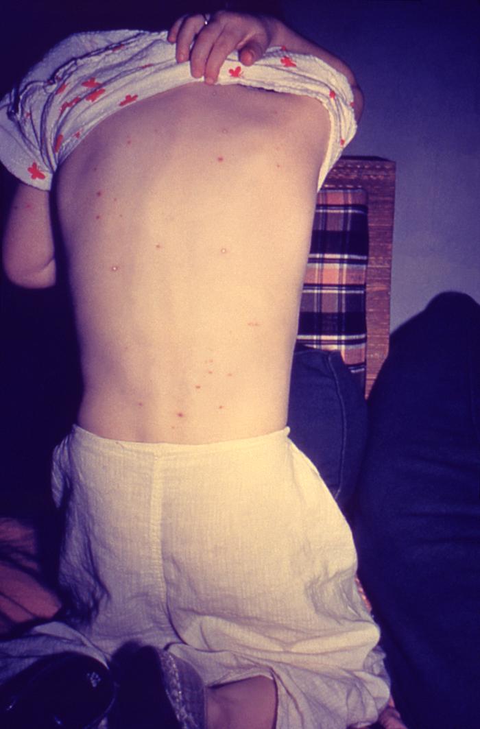 Back of boy who had manifested the maculopapular rash that was determined to be chickenpox, also known as varicella-zoster virus (VZV). From Public Health Image Library (PHIL). [23]
